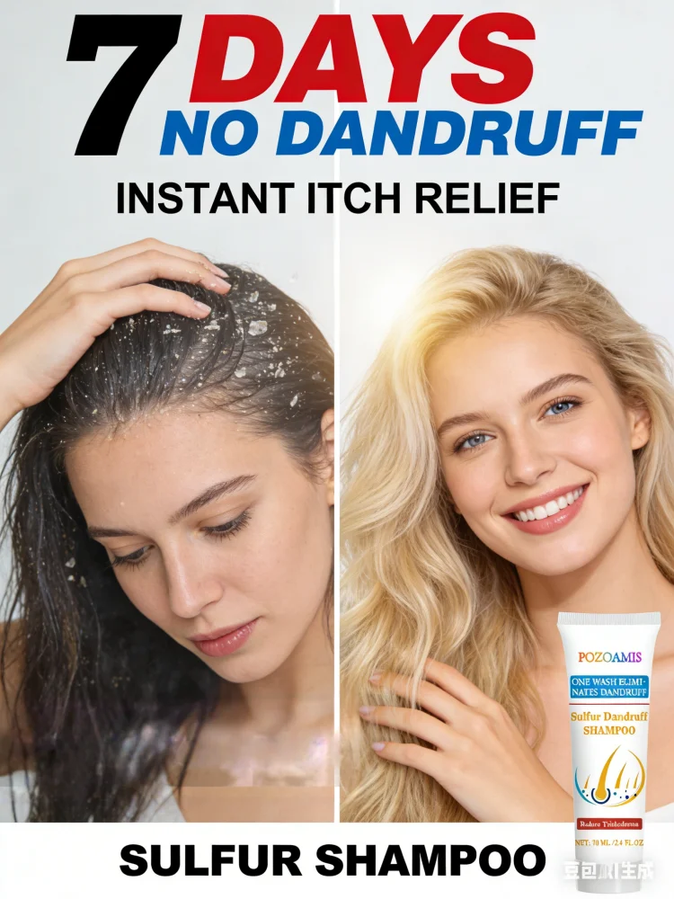 

Серный шампунь от стойкой перхоти: быстрое средство от зуда