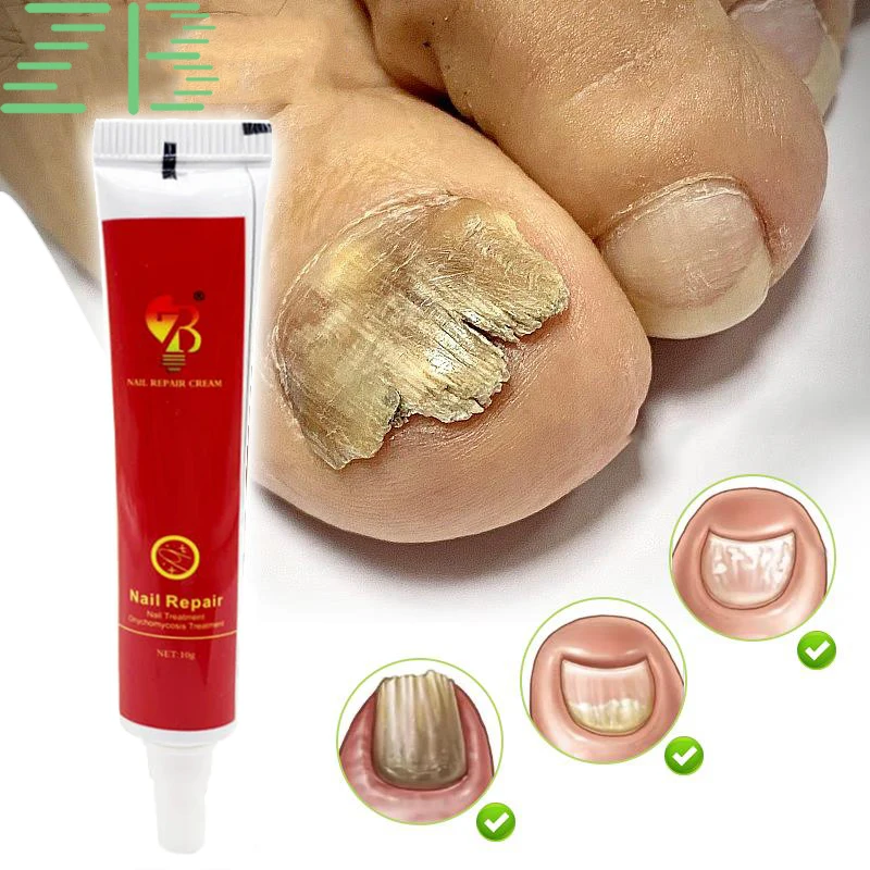 10g Nail Fungus Removal Cream Onychomycosis Fungal Ointment Nail Paronychia Cream Anti Feet Toe Fungal Toenail Care Ointment