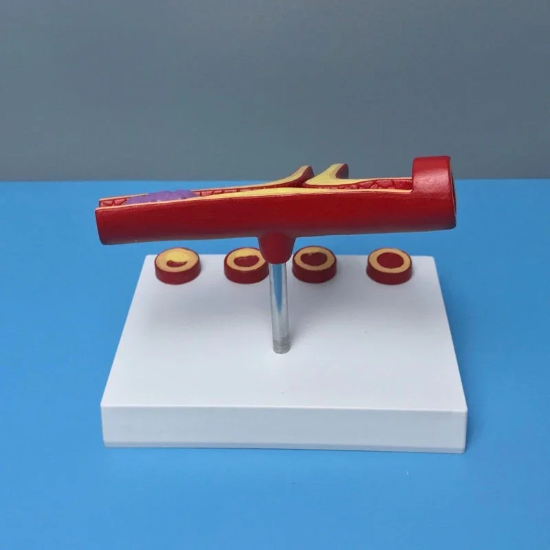 

Vascular Model Human Arteriosclerosis with Thrombus Atherosclerosis Process Display Teaching Medical Explanation