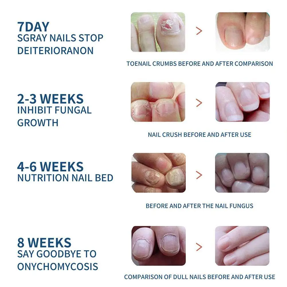 32Pcs/Box Universal Nail Ditch Repair Patch Compact Nail Repair Stickers Ingrown Toenail Correction Sticker Foot Care