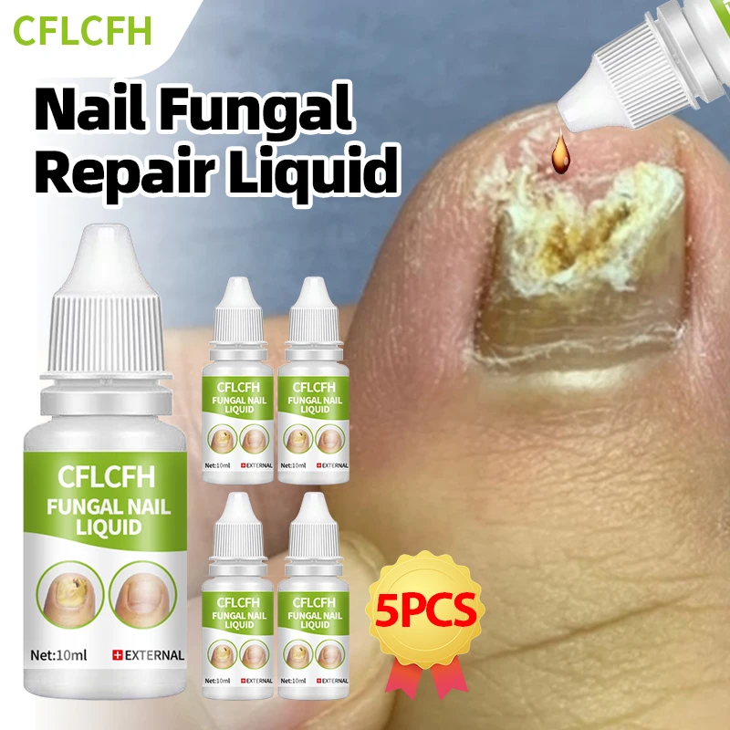 Nail Fungus Treatment Essence Offers Toe Paronychia Relief and Onychomycosis Therapy,and Ingrown Toenail Removal Liquid