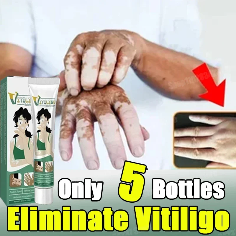 Vitiligo White Spot Repair Cream Face Body Discoloration Skin Vitiligo Cream