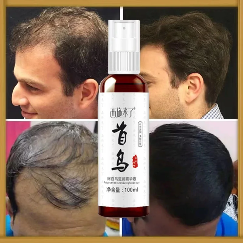 

Anti-hair LossSpray Fast Hair Growth Nutrition Serum Alopecia Treatment Prevent Dry Frizzy Damaged Improving Hair Follicle Tonic