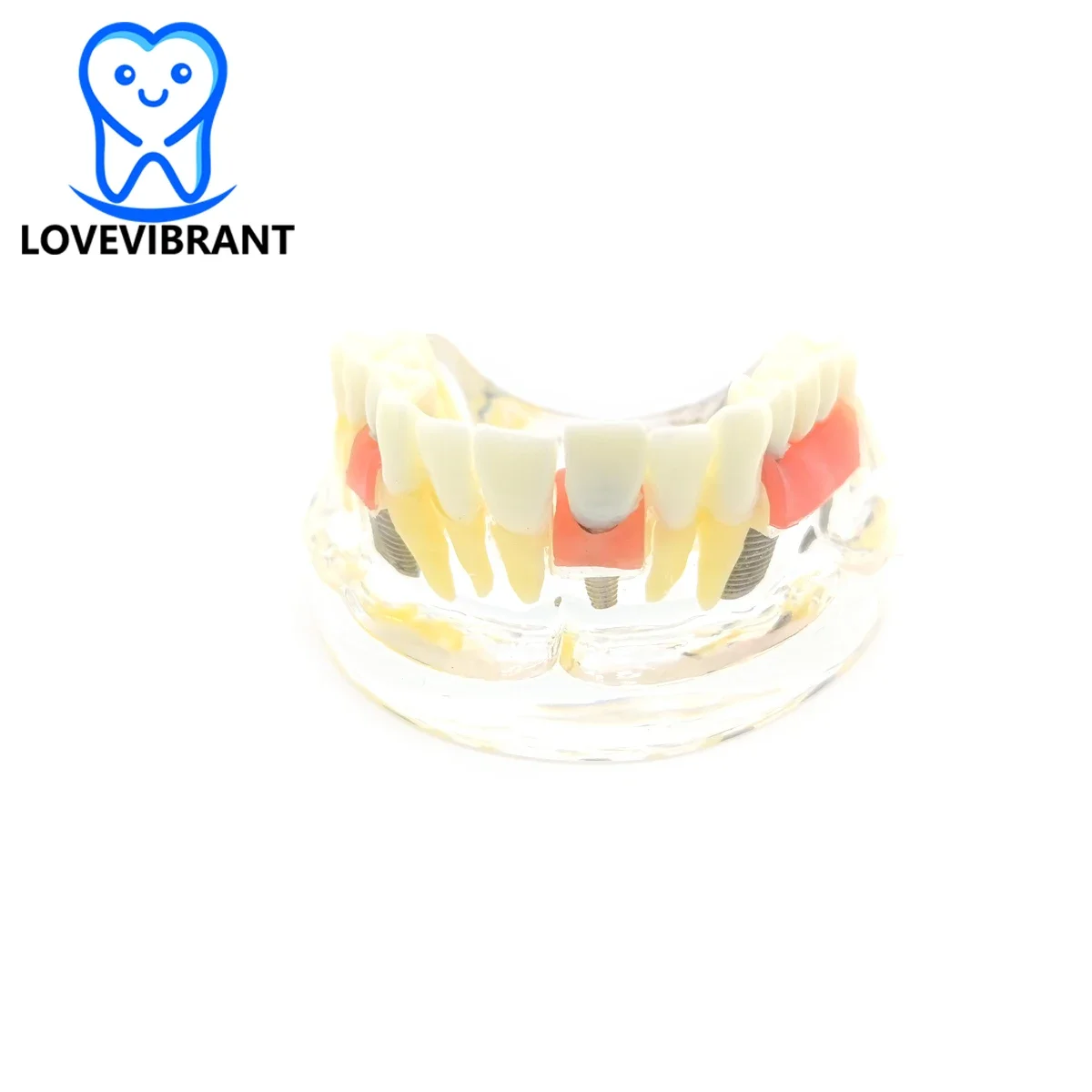 

Dental Teeth Model Transparent Dental Caries Implant Dentistry Teaching Model With 3-unit Removable Bridge Dental Products