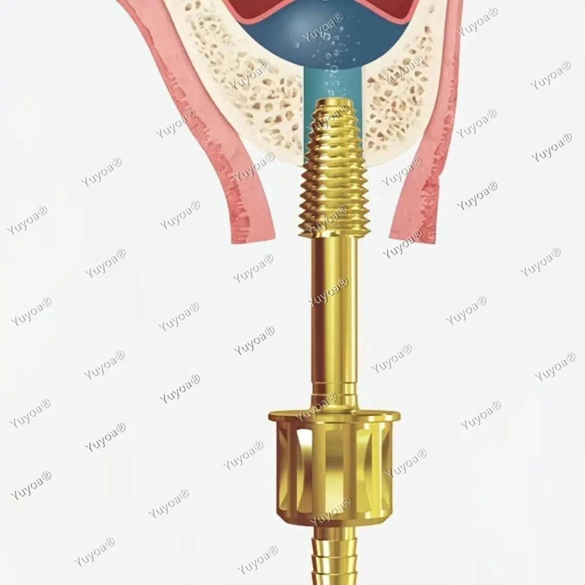 3Sets Dental Maxillary Sinus Lift Membrane Water Rising Hydraulic Lifter Aqua Tip Water Pipe Leak-Proof Seal Crestal Guide Drill