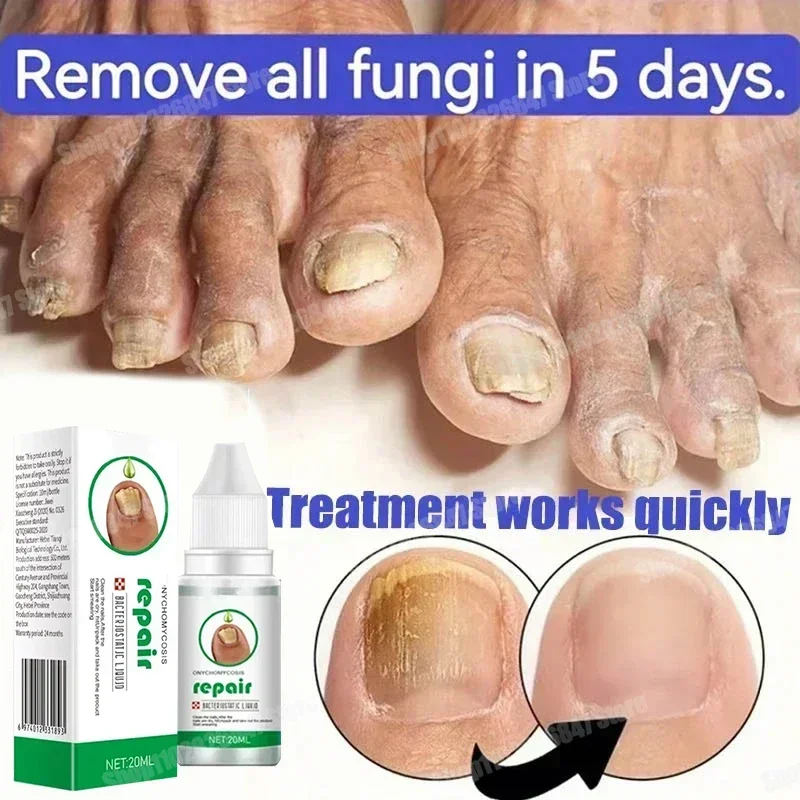 Fungal Nail Treatment Oil Foot Repair Essence Toe Nail Fungus Removal Gel Anti Infection Cream Fungal Nail Removal Paronychia