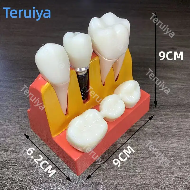 Oral Dental Implant Demonstrator, 4 Times Magnified Model with Detachable Implant Screw & Crown