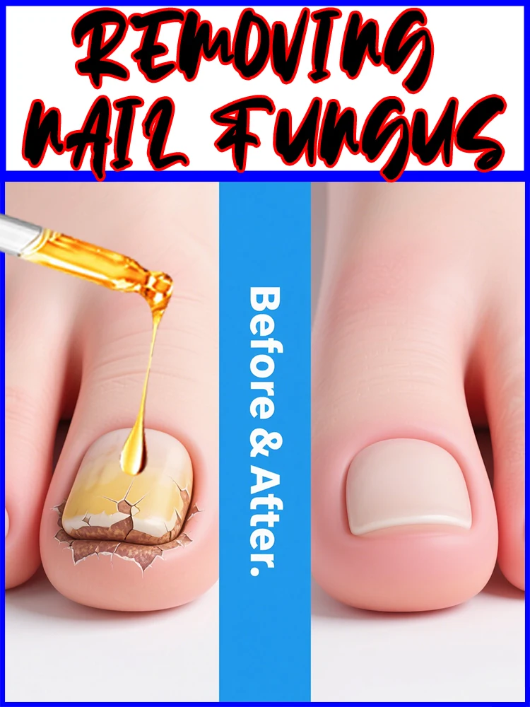 

Antifungal Nail Oil for Toenail Fungus, 10ml Tea Tree Blend