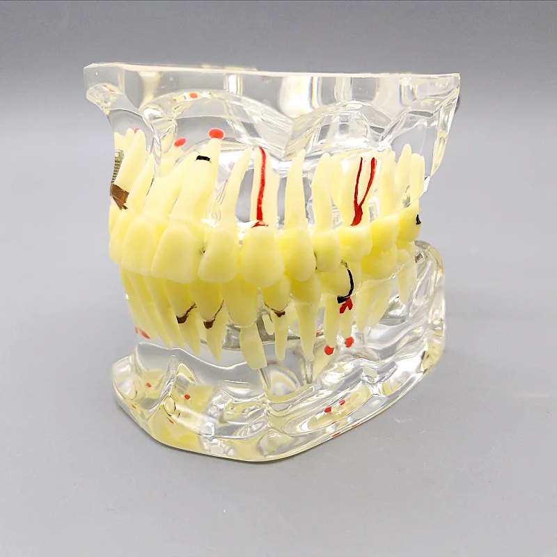 

Dental material Oral tooth pathology model free shipping