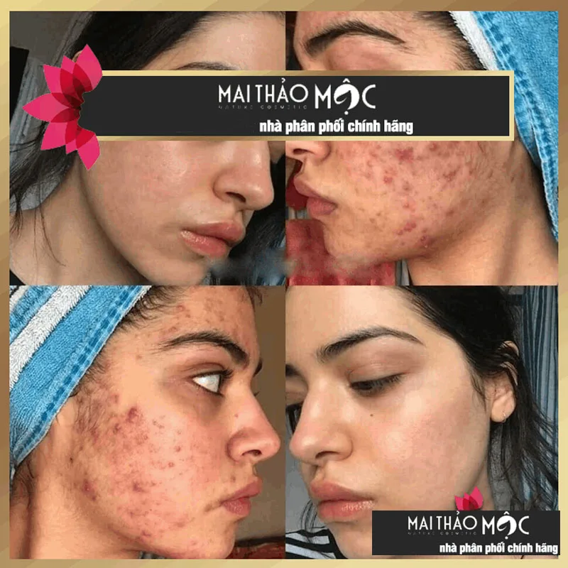 ماي ثيا خور دكتور ماي نوكواد 5 مل لعبة الخنزير المهام الشوك تشو دا نغلق كسه تشيسين هانغ، مزيل حب الشباب، البشرة الحساسة المناسبة