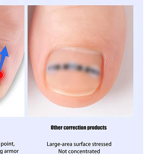 

Ingrown Toenail Corrector Clip Brace Tools Pedicure Recover Embed Toe Nail Treatment Professional Ingrown Toenail Straightening