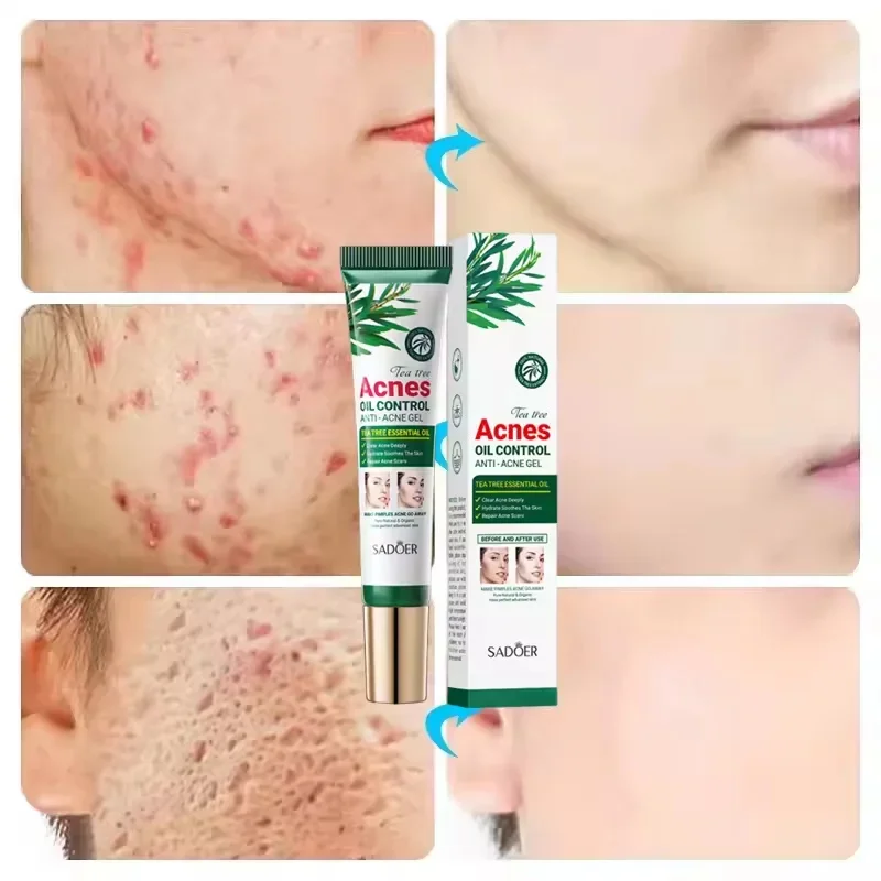 شجرة الشاي كريم إزالة حب الشباب الوجه ترطيب خفيف السيطرة على النفط حب الشباب إزالة هلام الوجه القضاء على حب الشباب البثور الصحة الجمال