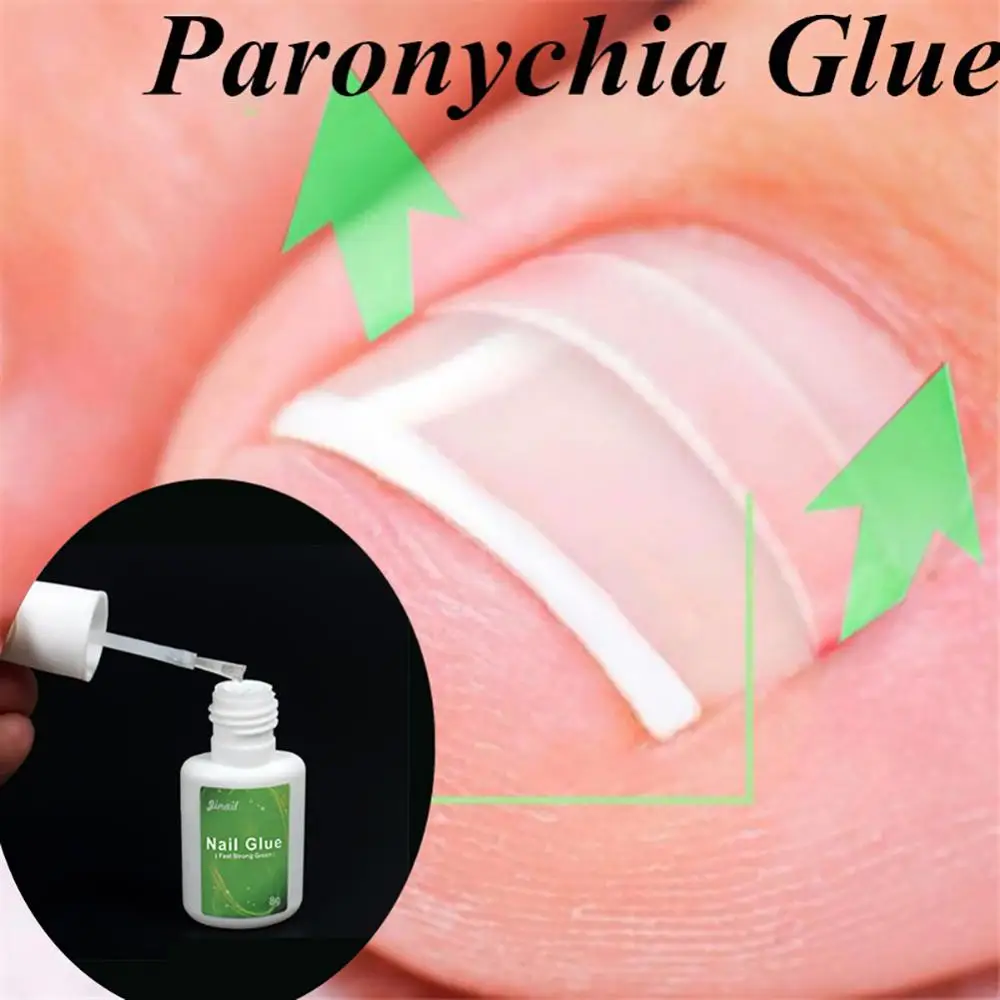 8G Paronychia Nagellijm Ingegroeide Teennagel Correctie Pedicure Teen Patch Voetverzorging