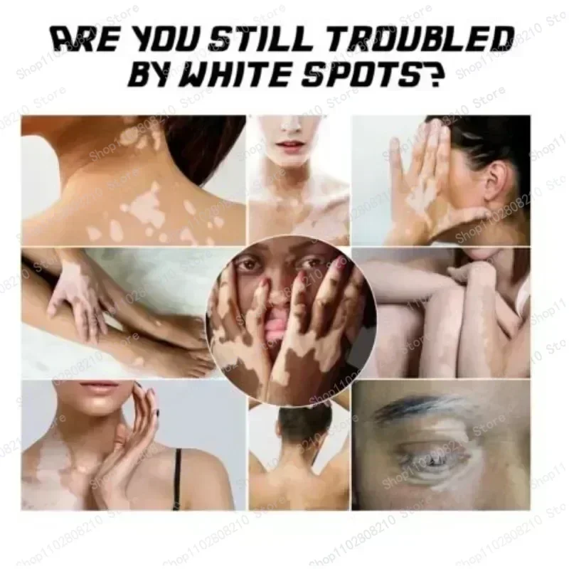 Reduce White Spots Eliminate Vitiligo Skin Care Products 1006