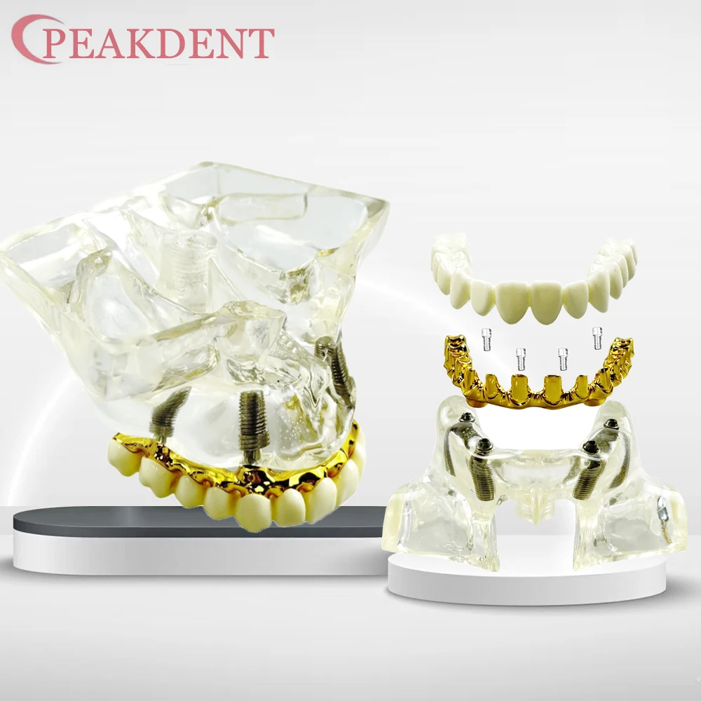 

Модель зубного имплантата с протезом для восстановления зубов нижней челюсти, съемная, на 4 имплантата, для обучения и исследований стоматологов