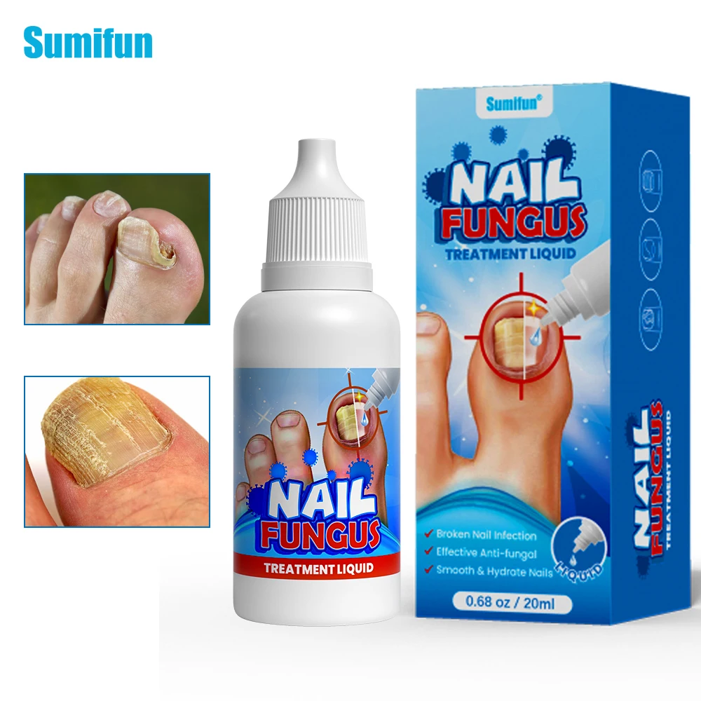 

1/2/3Pcs Sumifun Nail Fungus Liquid Treat Toe Paronychia Antibacterial Fluid Onychomycosis Antifungal Massage Health Care Cream