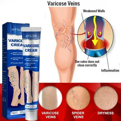 Effective Relief Varicose Vein Ointment Relieve Varicose Vein Vasculitis Spider Legs Pain Treatment Care Essential Cream