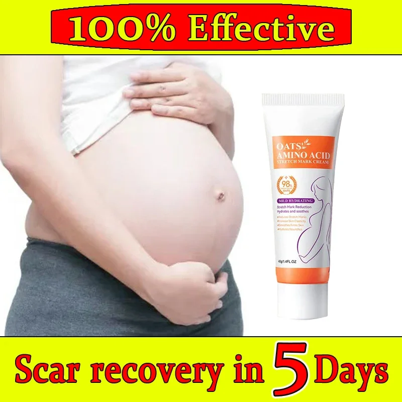 

Acne Scar Stretch Marks Remover Cream Postoperative scar repair Skin Repair Acne Black Dots Spots Acne Treatment Cream