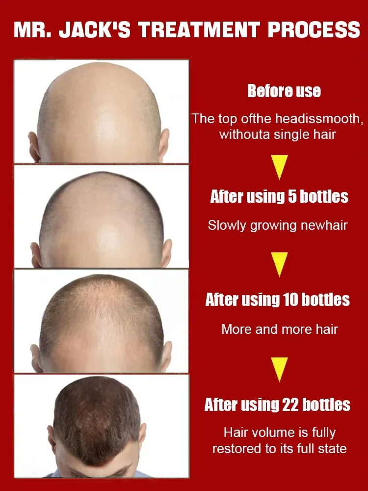 Hot selling hair growth products, fast, help, hair, grow. Fix hair loss, fix baldness.