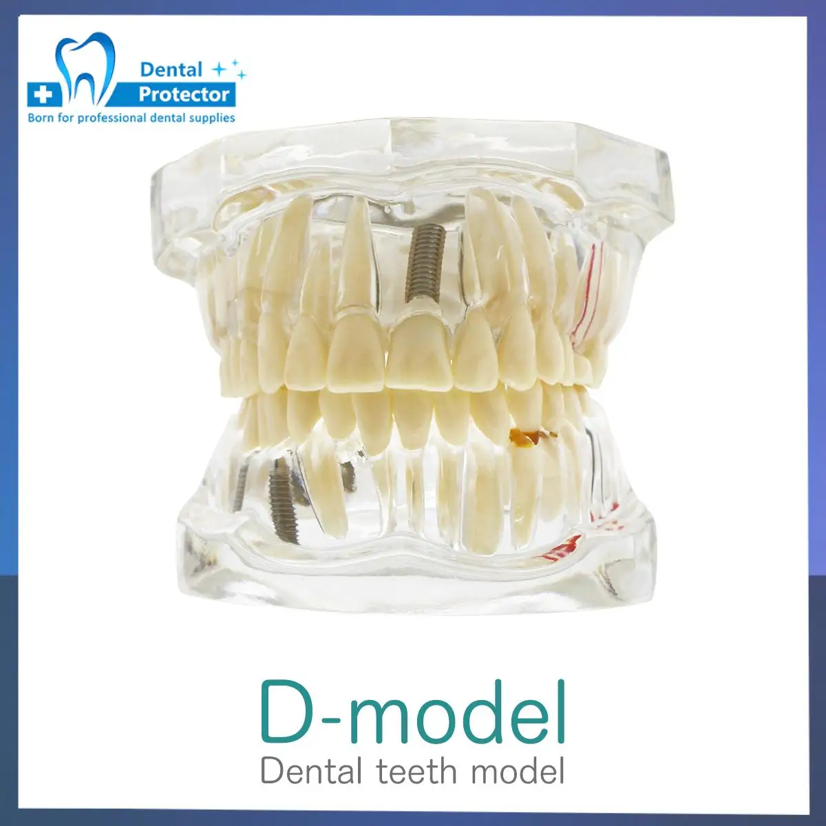 Dental Implant Demonstration Model Teeth Study Teach Model Disease Analysis with Restoration Crown Bridge Maxillary Mandibular