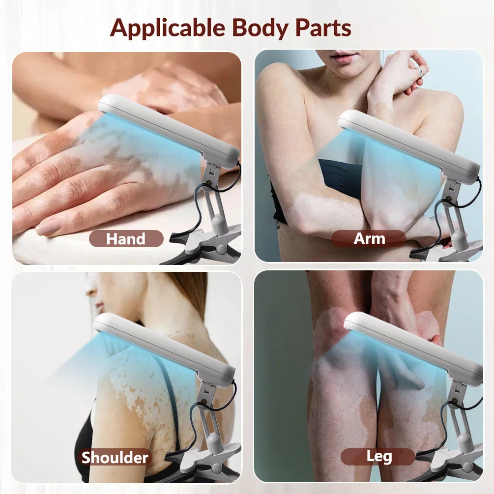 Instrumento de terapia de banda estrecha UVB de 311nm, lámpara de fototerapia UV para lámpara de terapia de Vitiligo, tratamiento de enfermedades de la piel de la Psoriasis en el hogar