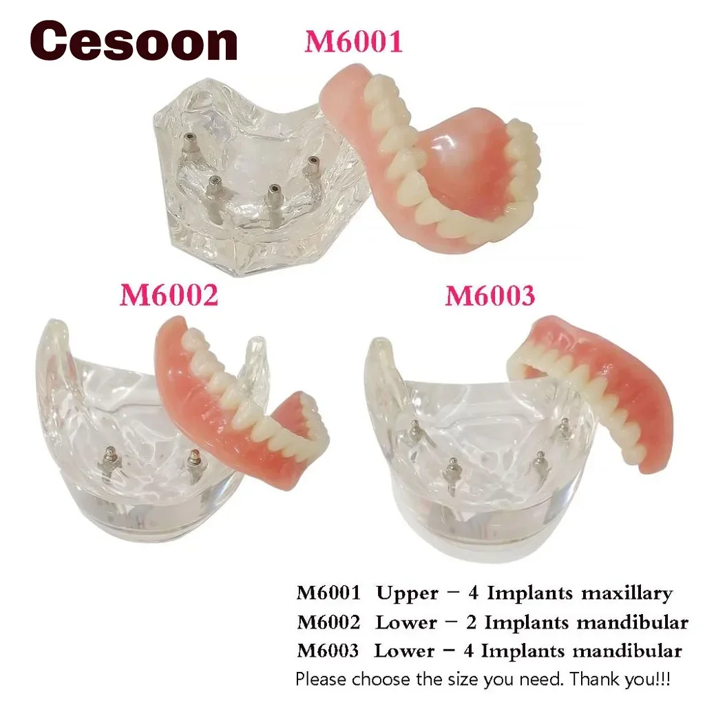 

Dental Implant Teeth Model 4/2 Implants Overdenture Restoration Acrylic Upperand Lower Jaw Base Removable Interior Mandibular