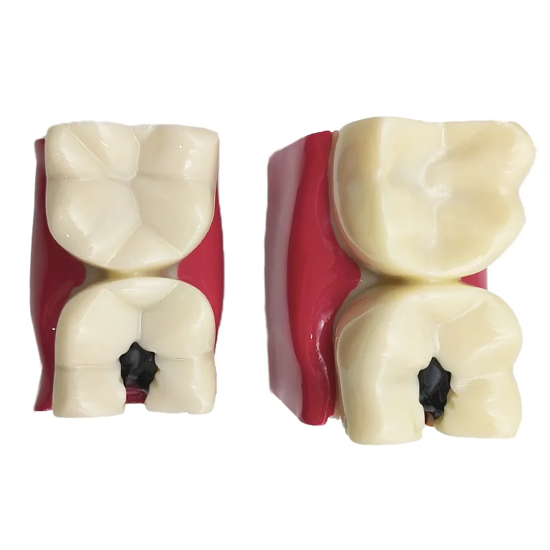 8 Times Dental Caries Model Disease Teeth Dental Model for Dental Demonstration Model Dentist Teaching Dental Lab Oral Research