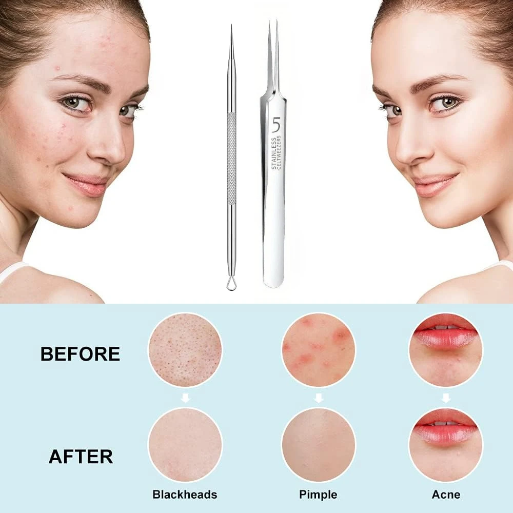 Pimple Extractor Tools, Blackhead Remover, Pimple Popper, Acne Removal Kit Risk Free Treatment for Blemish,Blackhead Tweezers