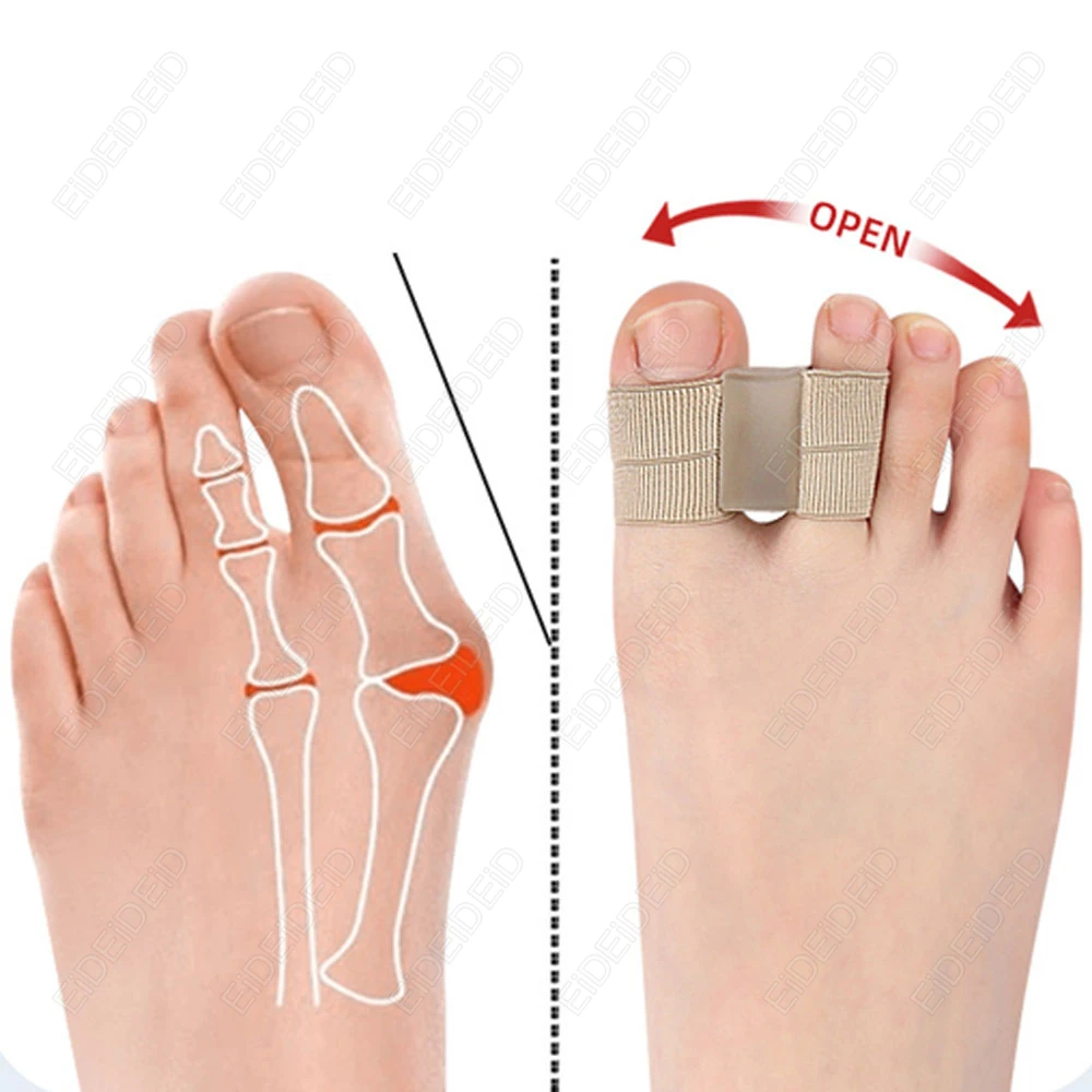 Bunion Toe Corrector Orthesen Füße Knochen Daumen Teller Hallux Valgus Bunion Corrector Haarglätter Fußpflege Werkzeuge Mann Frauen – Detail 8