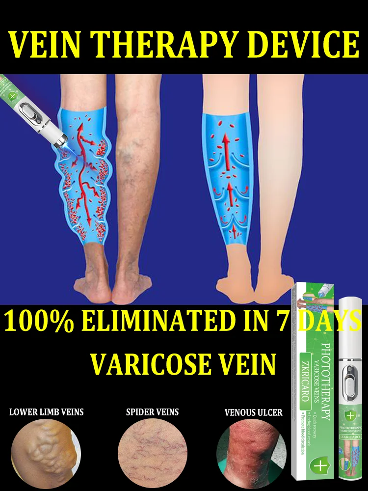 

laser vein