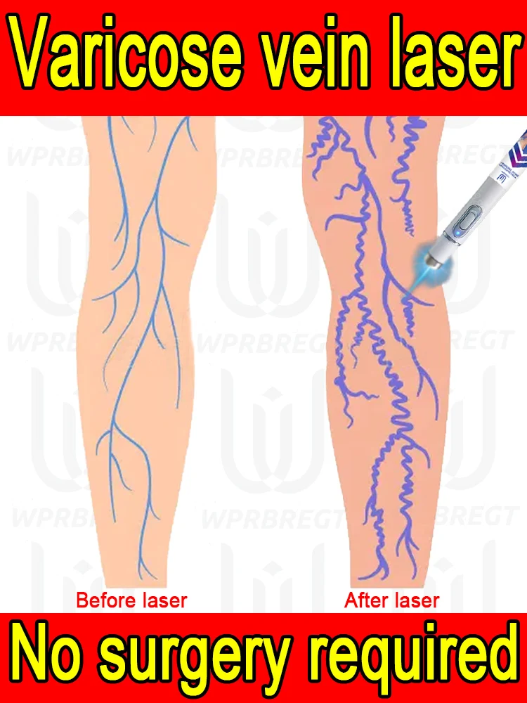 

2nd generation phlebitis elimination laser, spider veins, swollen veins, varicose veins