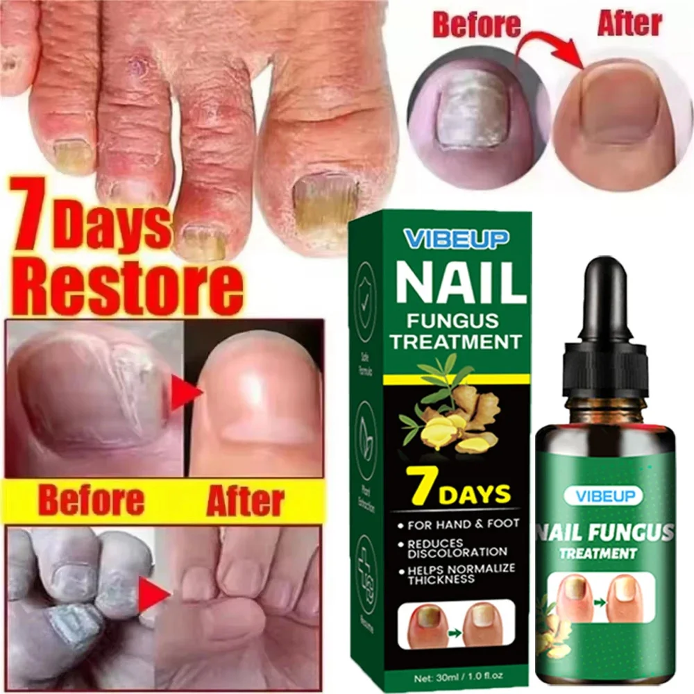 

7 Days Nail Fungus Treatment Serum Ginger Anti-infective Paronychia Onychomycosis Toe Foot Nail Fungal Repair Gel Hand Foot Care