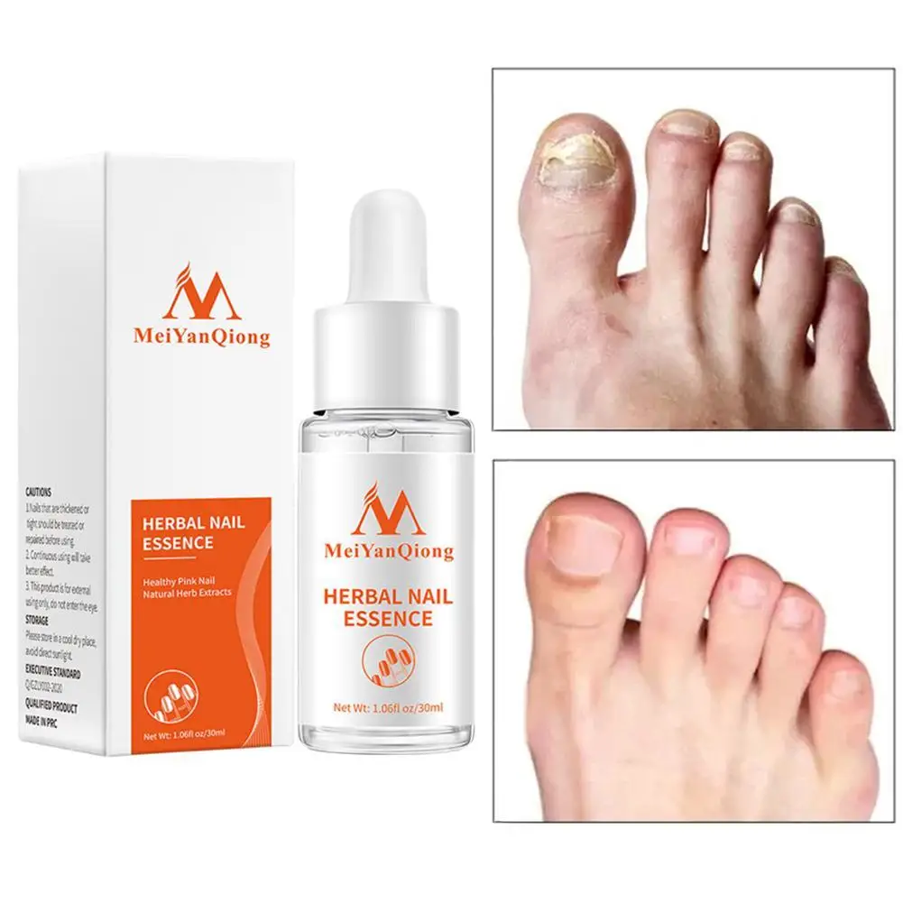 Fungal Nail Treatment Serum Onychomycosis Paronychia Anti-Fungal Nail Infection Herbal Toe Fungus Foot Repair Essence Care 30ml