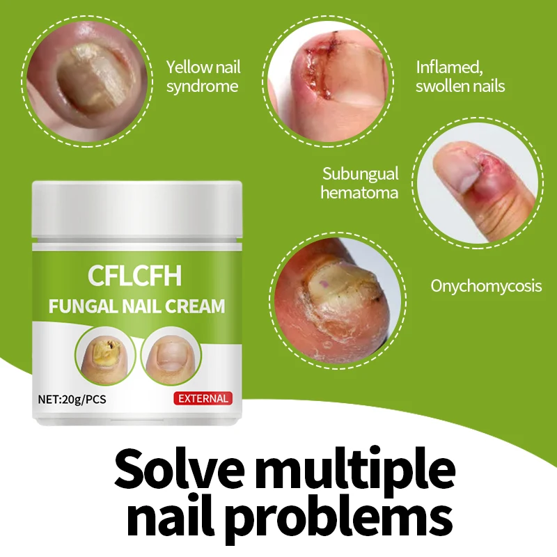 Nail Fungal Treatment Cream Onychomycosis Repair Nail Ointment Correction Paronychia Anti Infection Toe Fungus Removal Foot Care