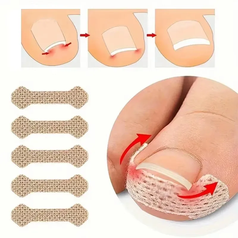 10pcs Ingrown Paronychia Toenail Corrector Strips Anti Nail Patch Feet Sleeping Nail Patch Nails into the Flesh Long Toe Pad