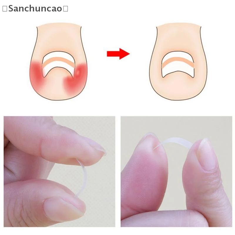 〔San〕100 Pcs Ingrown Toenail Correction Tool Ingrown Toe Nail Treatment Elastic Patch Sticker Straightening Clip Brace Pedicur