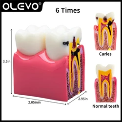 Model zębów dentystycznych 6-krotny próchnica badanie porównawcze Model próchnicy zębów Model demonstracyjny protezy Model szkolenia anatomii dentysty