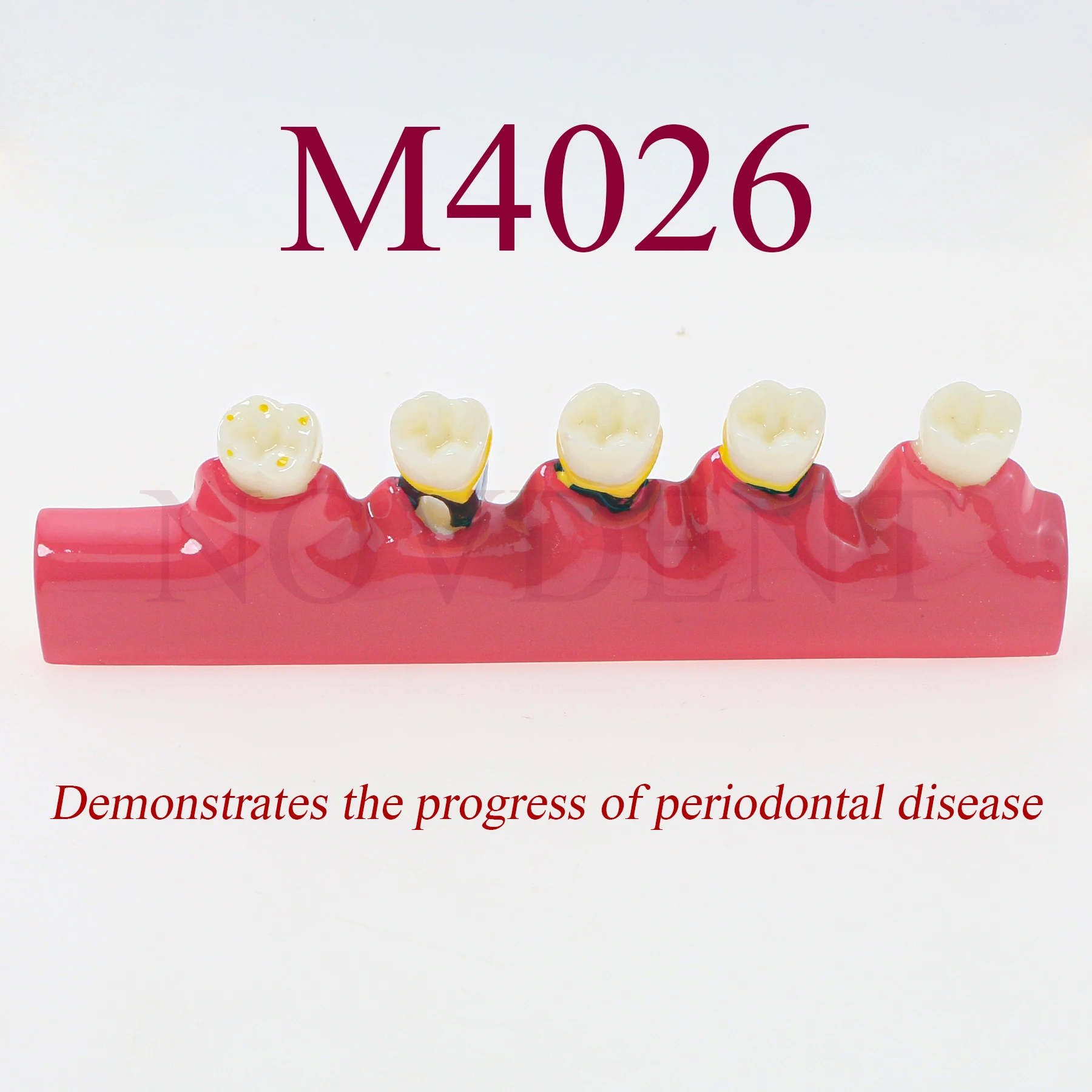 Modelo de dentes dentários m4026, modelo de doença periodontal, cárie, processo de classificação de doença periodontal, modelo de comunicação de dentista