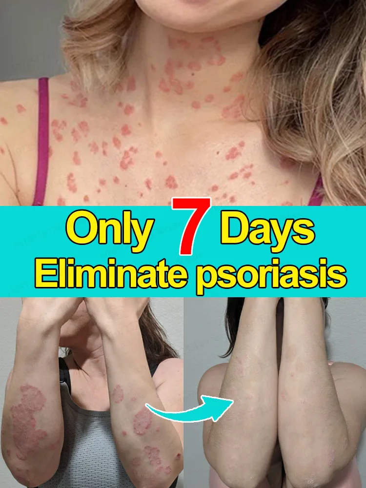 Healthy skin, happy self  ᴏᴠᴇʀᴄᴏᴍᴇ ɪᴛᴄʜɪɴɢ, ᴄᴏᴍғᴏʀᴛᴀʙʟᴇ ᴇᴠᴇʀʏ ᴅᴀʏ