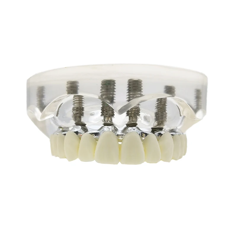 Dental Implant Model Transparent Upper Lower Jaw 6 Implants Overdenture Restoration Teeth with 6 Removable Screws Dental Demo