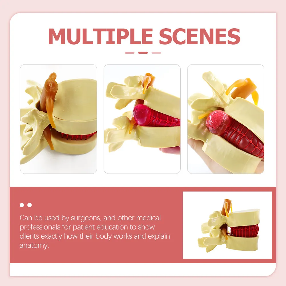 

Модель позвоночника человека с грыжей межпозвоночного диска и дегенеративными изменениями поясничных позвонков для обучения анатомии и демонстрации