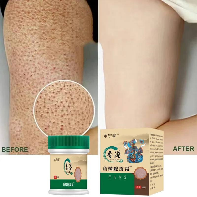 New Chicken Skin Repair Cream Curing Keratosis Follicle Pilaris Remove Thick Pores Body Dark Spot Moisturize Smooth Skin Care