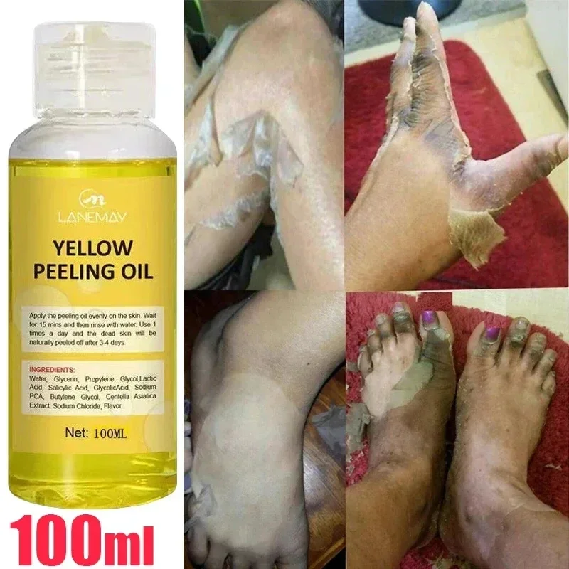 Body Care Exfoliating Yellow Peeling Oil 100% Organic Bleaching Dark Skin Serum Dark Knuckles Fast Whitening Cosmetics