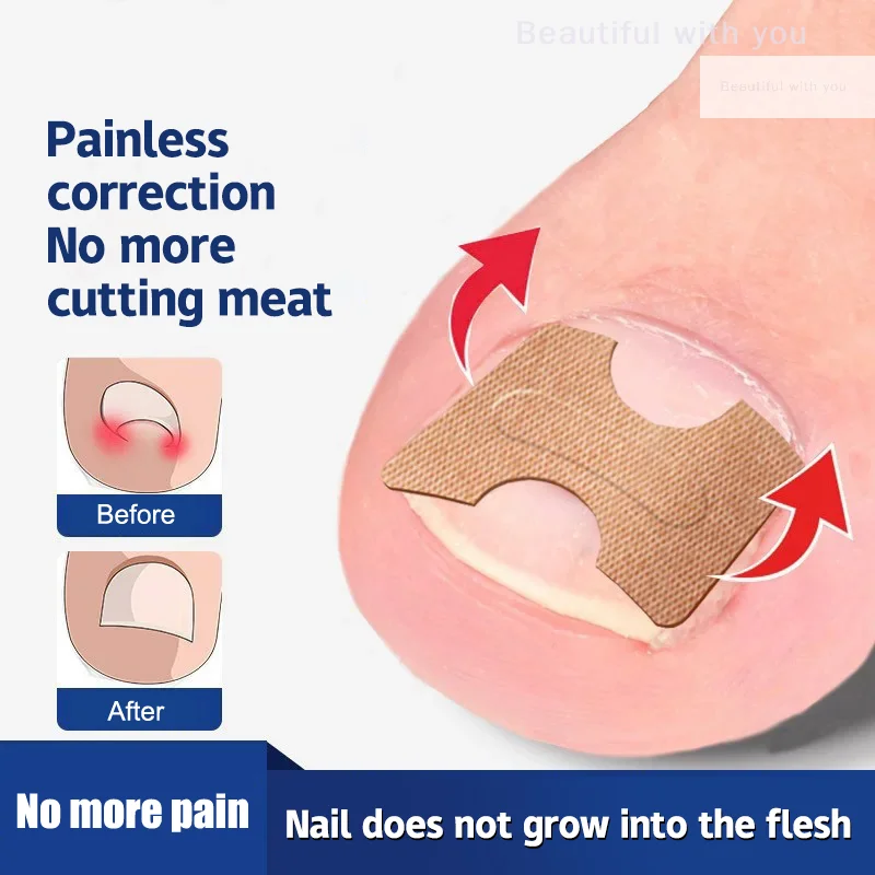 

NewIngrown Toenail Toe Correction Stickers Paronychia Treatment Recover Corrector Patches Feet Care Paronychia Treatment Recover