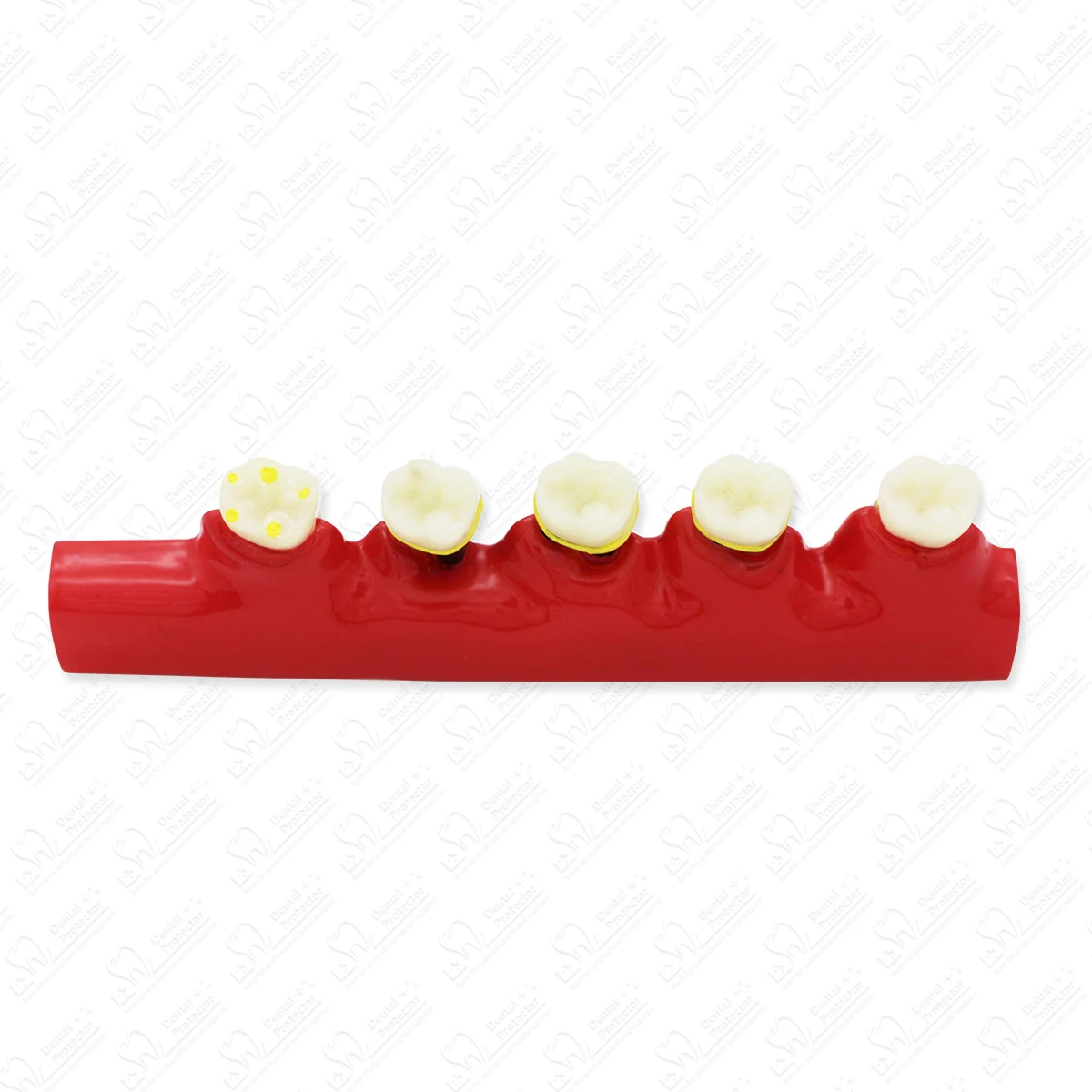 Dental Model Disease Tooth Model Tooth Dental Teaching Model for Dentist Teaching Training Learning Doctor-patient Communication