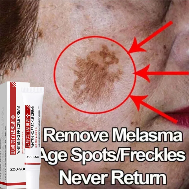 Effective Whitening Freckle Niacinamide Cream Remove Dark Spots Anti Freckle Cream Fade Pigmentation Melasma Creams Skin Care