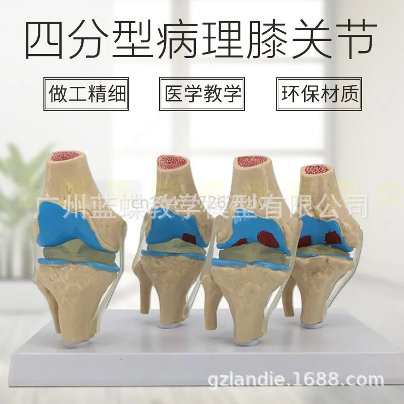 Pathological Knee Joint Model Four-Stage Pathological Knee Joint Model Pathological Human Knee Joint Model