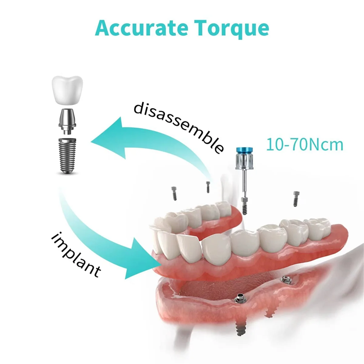 Le nouveau Kit d'implant dentaire, outil de tournevis à clé dynamométrique prothétique, clé dynamométrique manuelle, fixation/élimination du restauration des implants