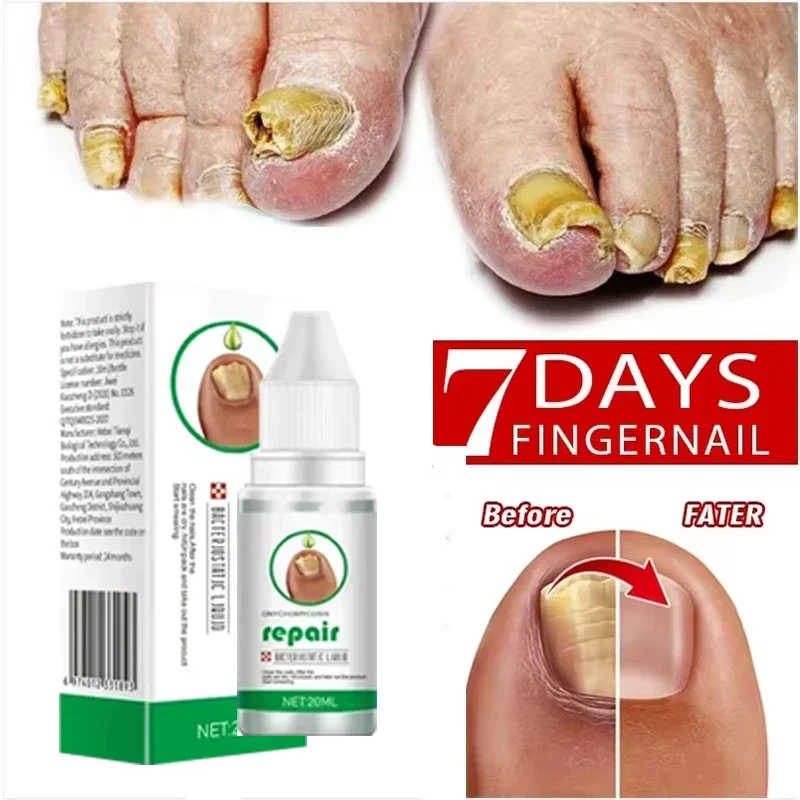 Fungal Nail Treatment Essence Oil Nail Fungus Repair Toenail Fingernail Treatment Onychomycosis with Mushrooms