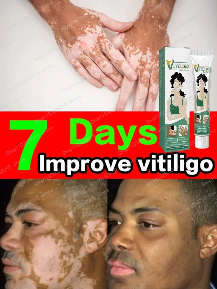 

Reduce White Spots Eliminate Vitiligo Skin Care Products 1006